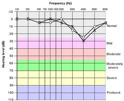 Severe Hearing Loss